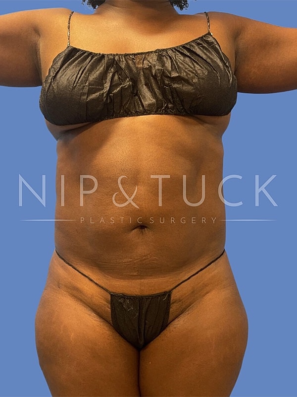 Liposuction Before & After