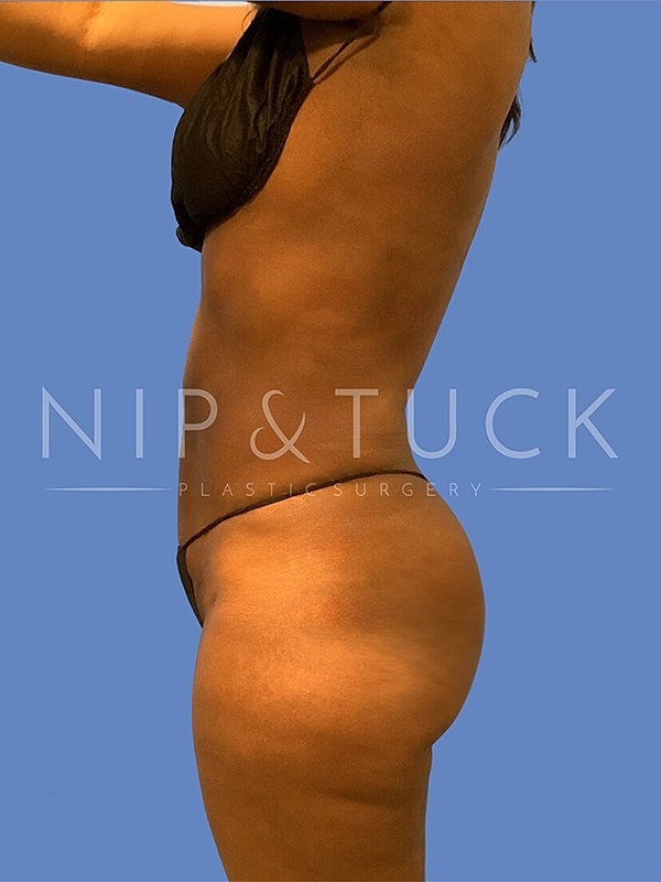 Liposuction Before & After