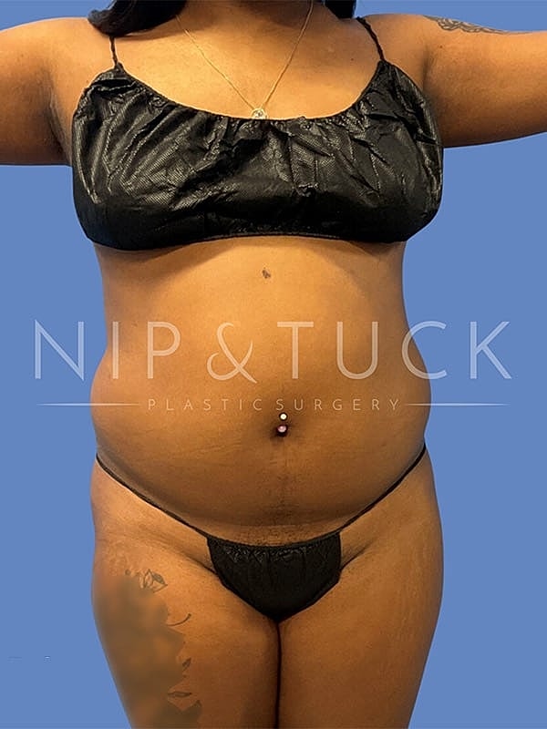 Liposuction Before & After