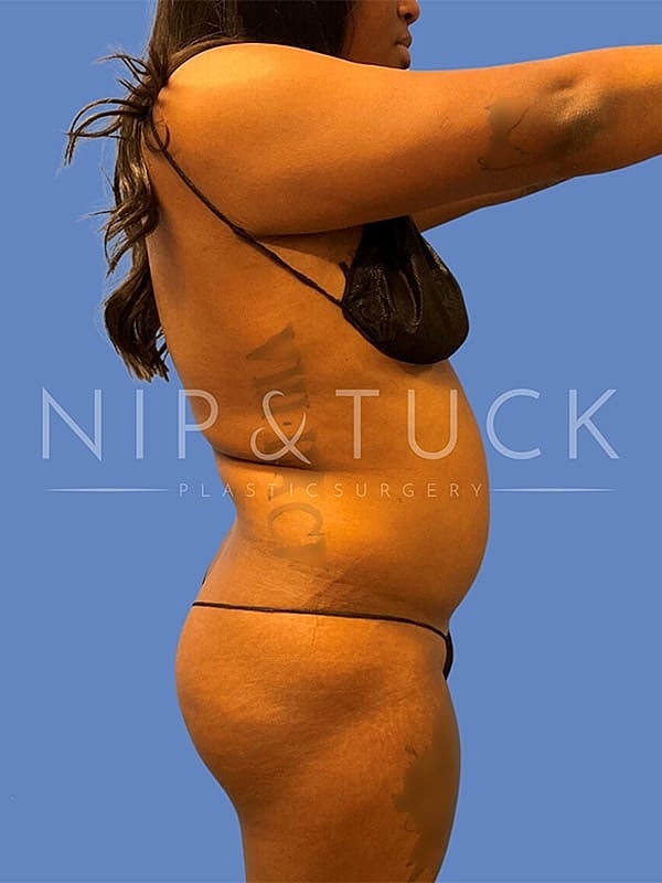 Liposuction Before & After