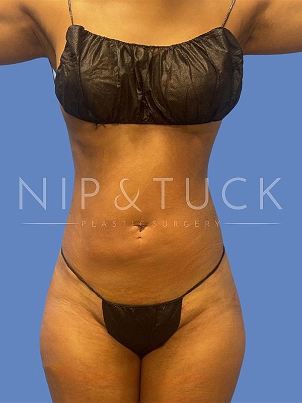 Liposuction Before & After
