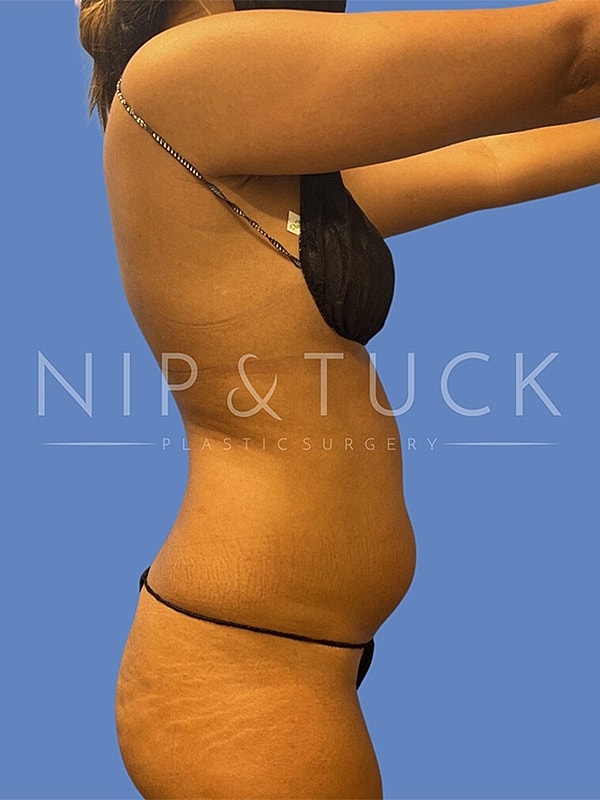 Liposuction Before & After