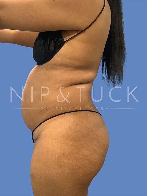 Liposuction Before & After
