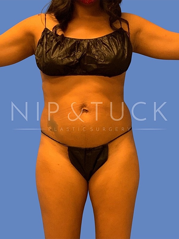 Liposuction Before & After