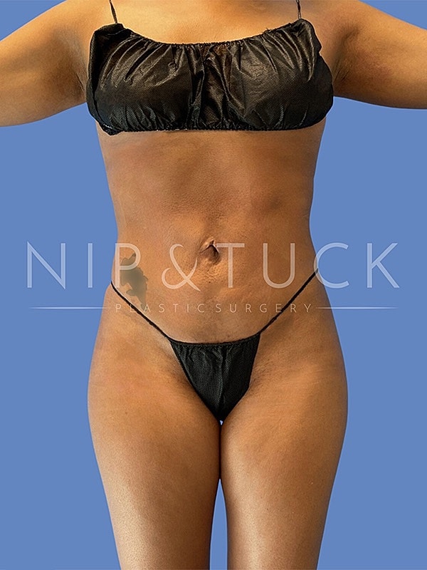 Liposuction Before & After