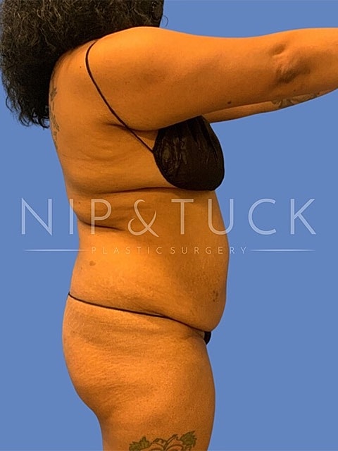 Liposuction Before & After