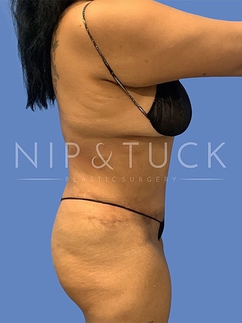 Liposuction Before & After