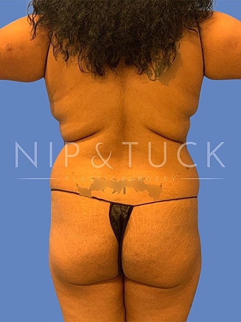 Liposuction Before & After