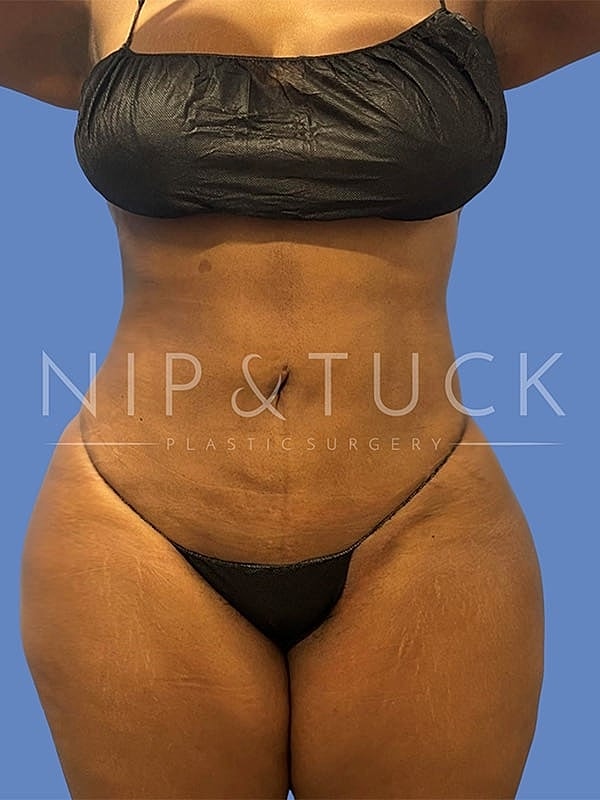 Liposuction Before & After