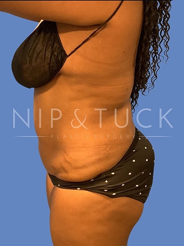 Liposuction Before & After