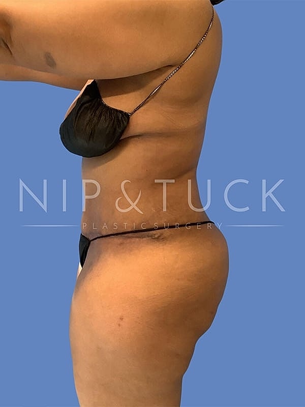Liposuction Before & After