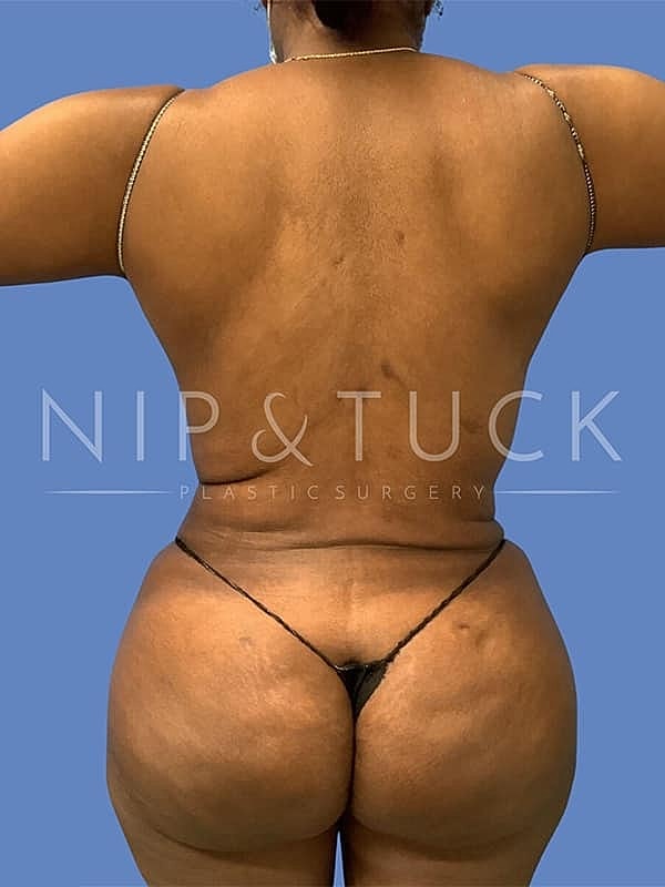 Liposuction Before & After