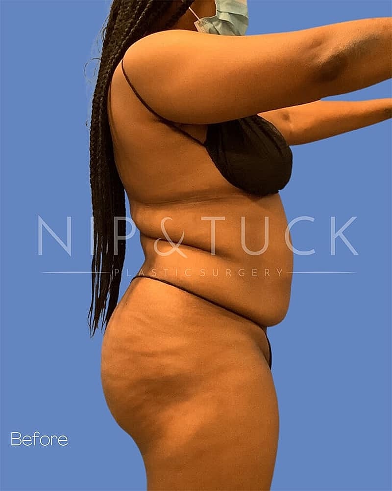 Liposuction Before & After