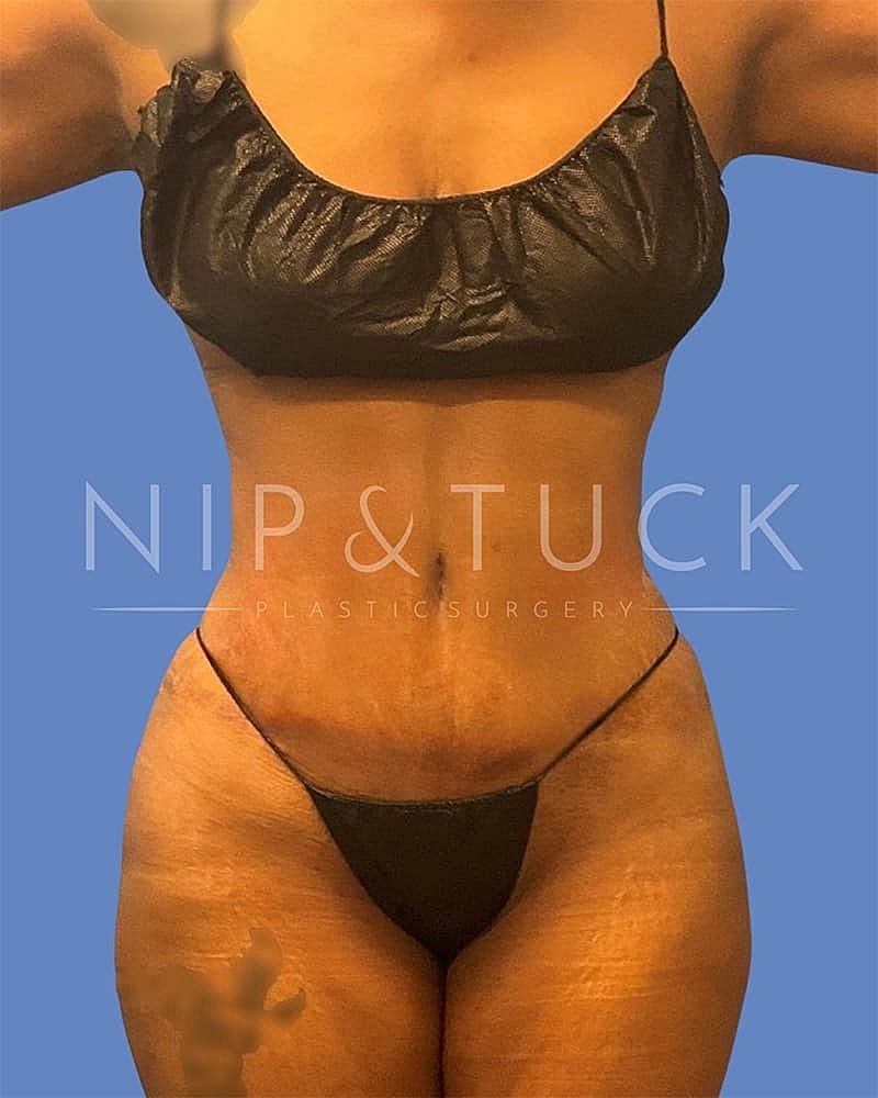 Liposuction Before & After