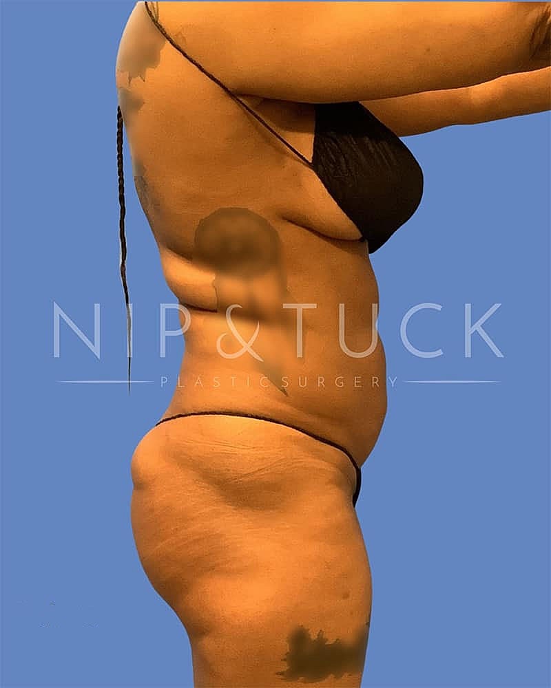 Liposuction Before & After