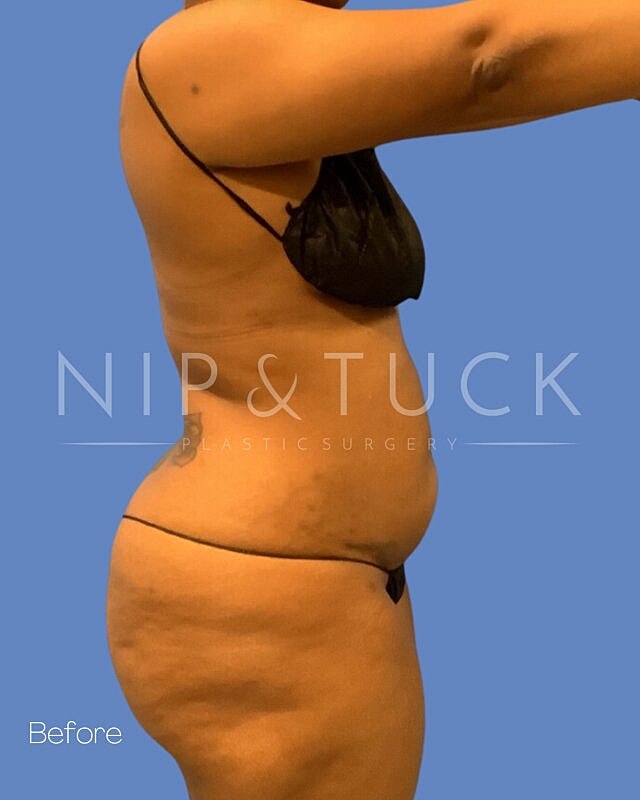 Liposuction Before & After