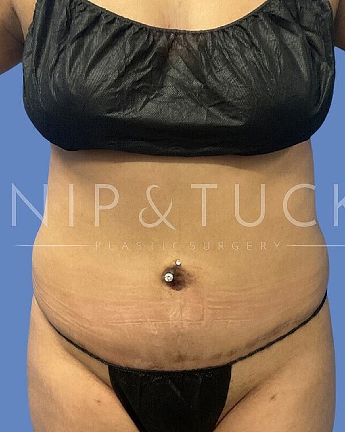 Liposuction Before & After
