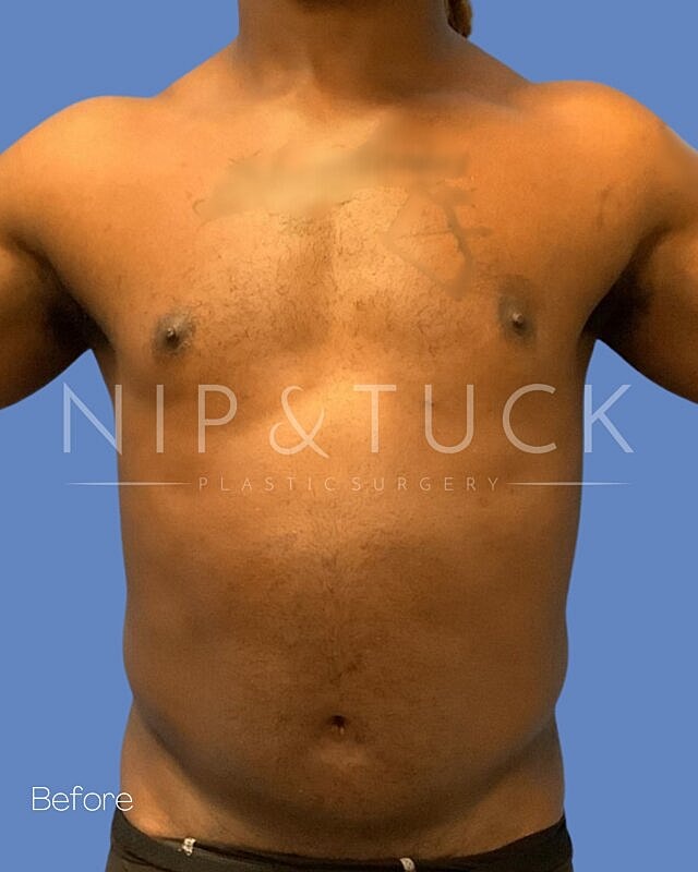 Liposuction Before & After