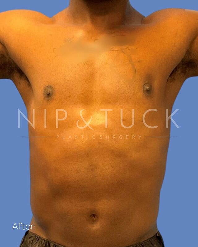 Liposuction Before & After