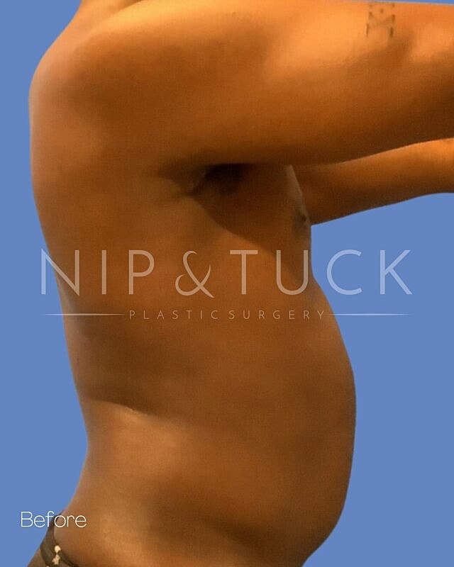 Liposuction Before & After