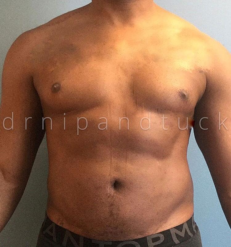 Liposuction Before & After
