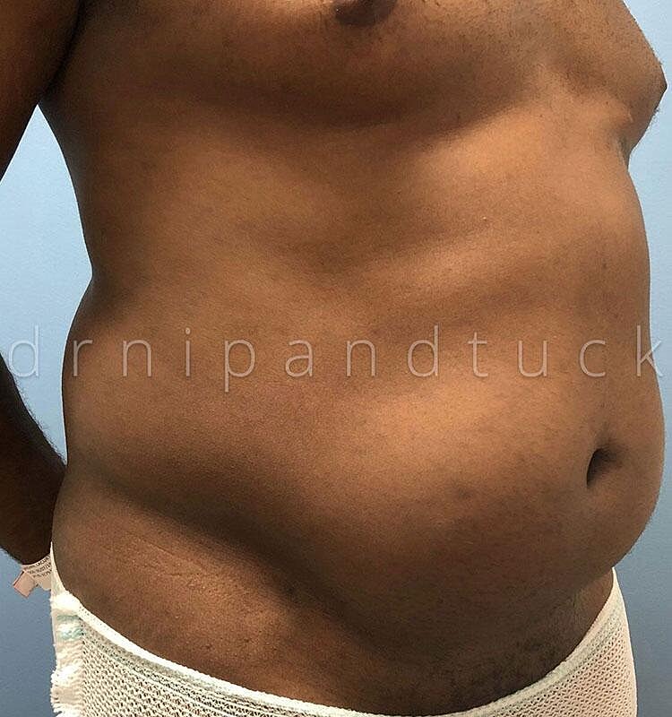 Liposuction Before & After