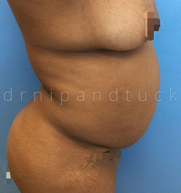 Liposuction Before & After