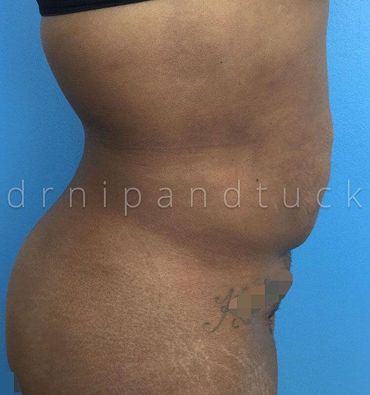 Liposuction Before & After