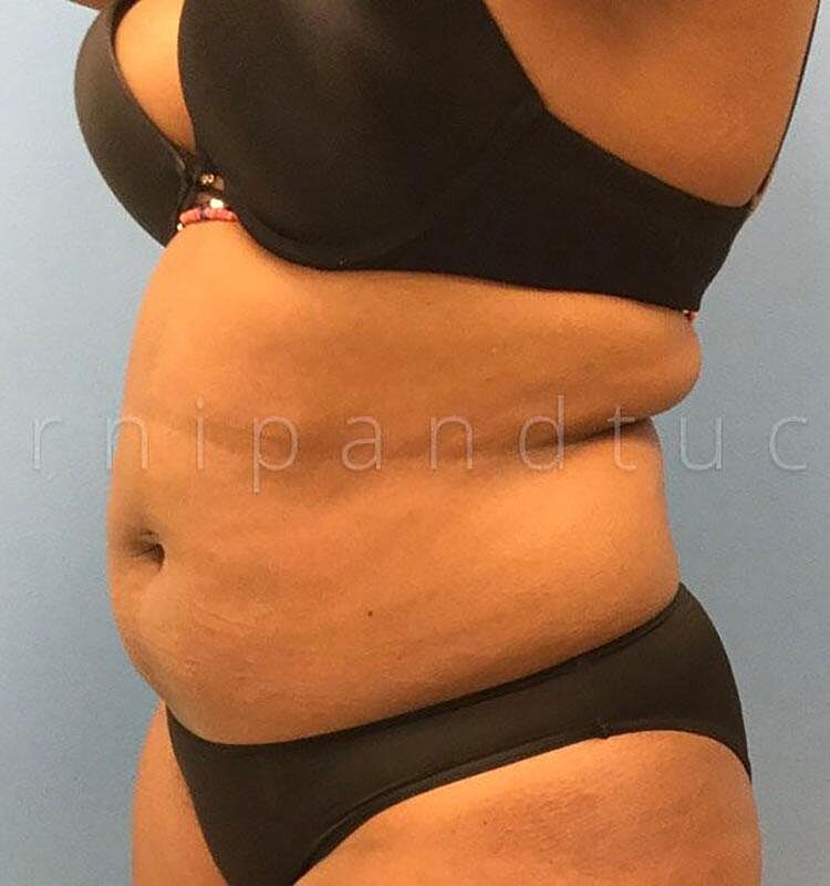 Liposuction Before & After