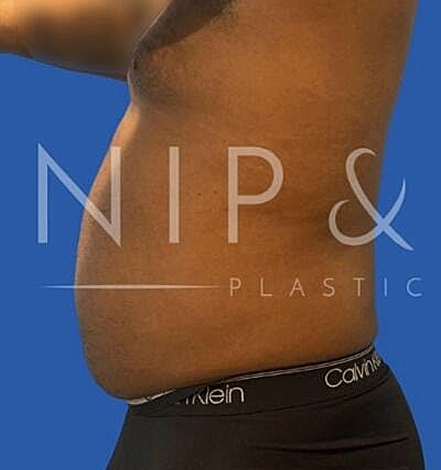 Liposuction Before & After