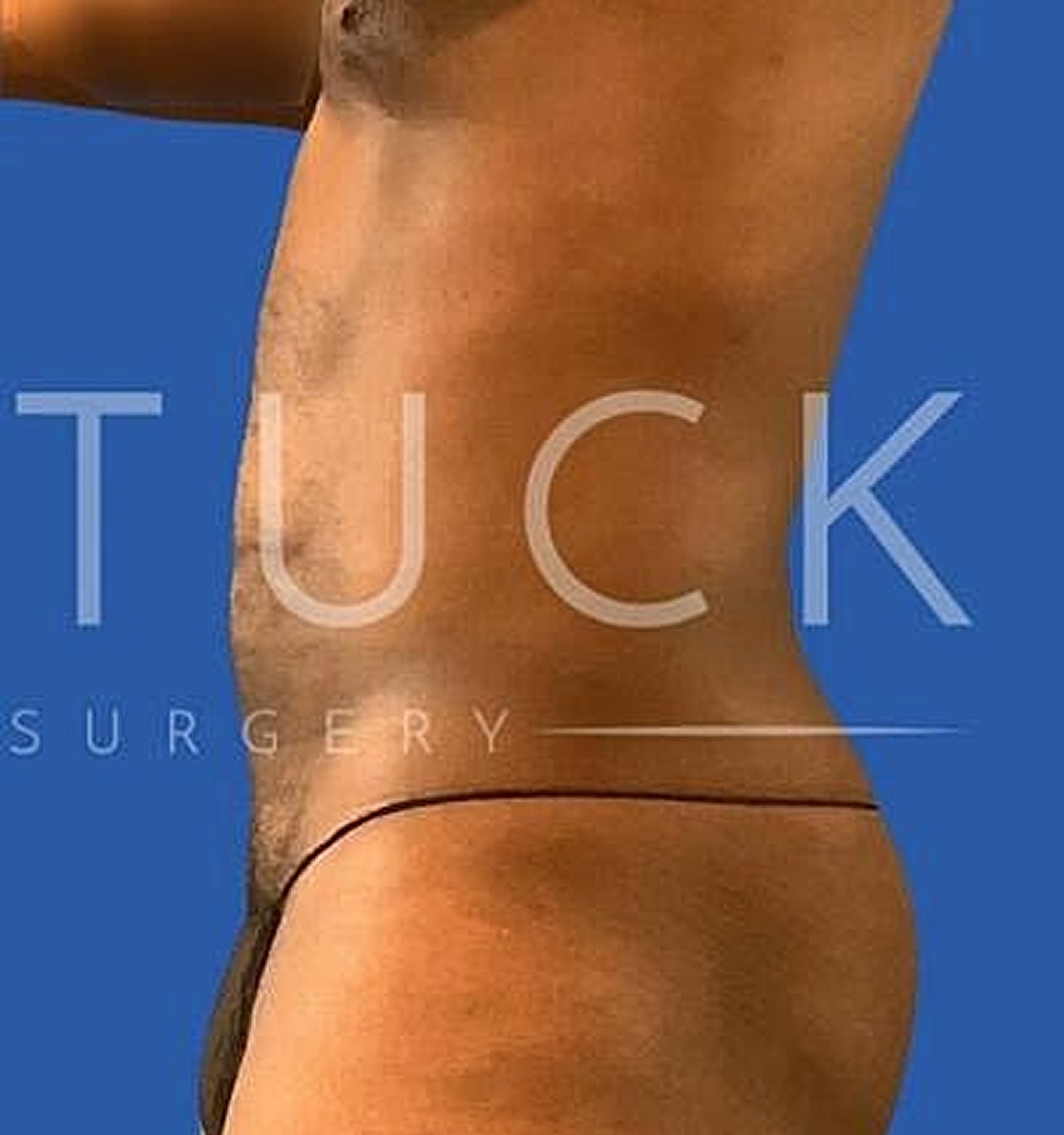 Liposuction Before & After
