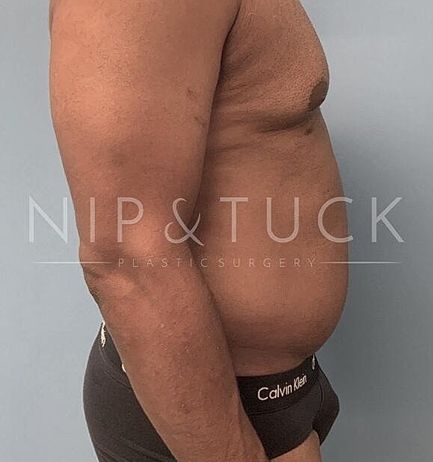 Liposuction Before & After