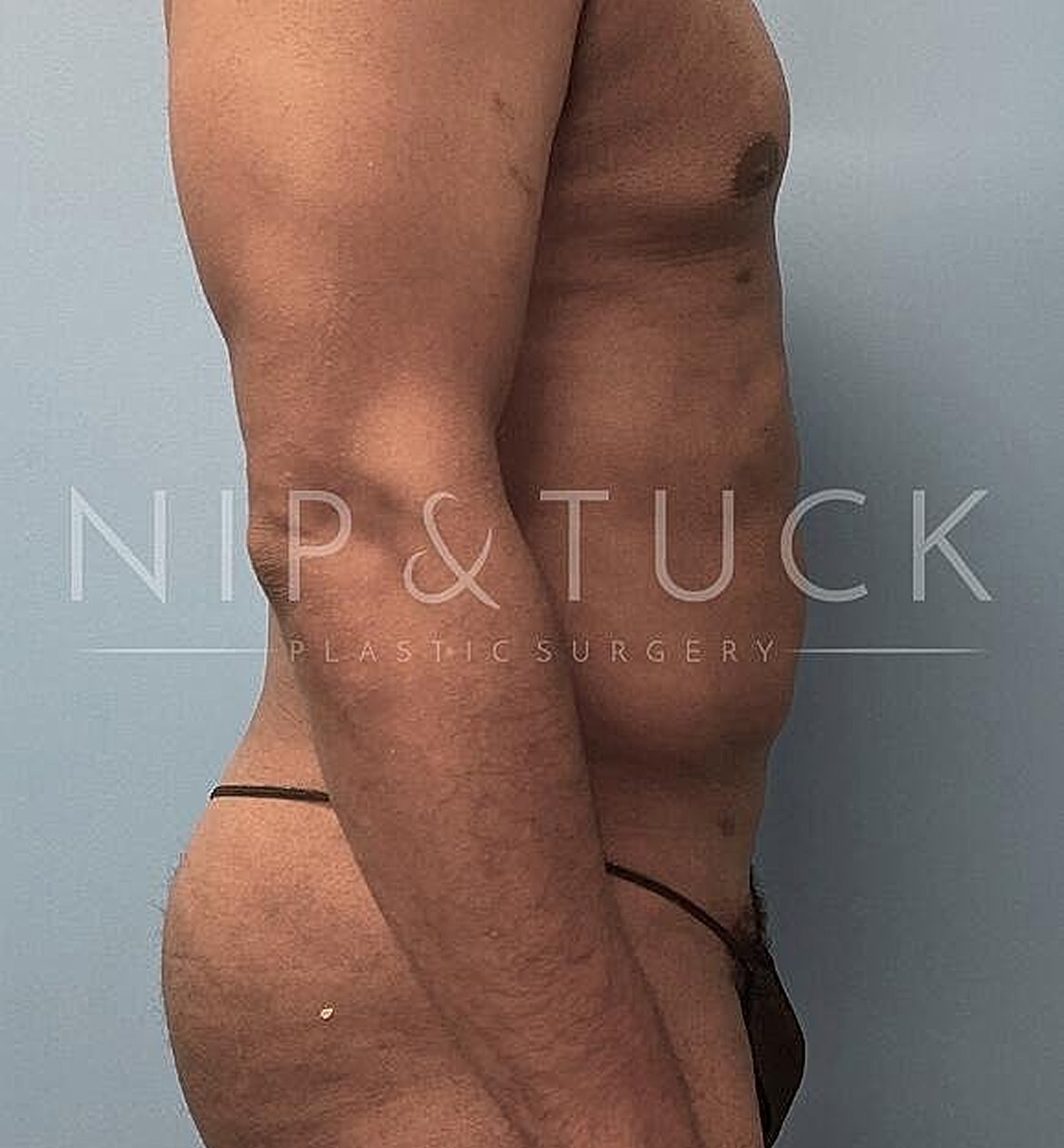 Liposuction Before & After