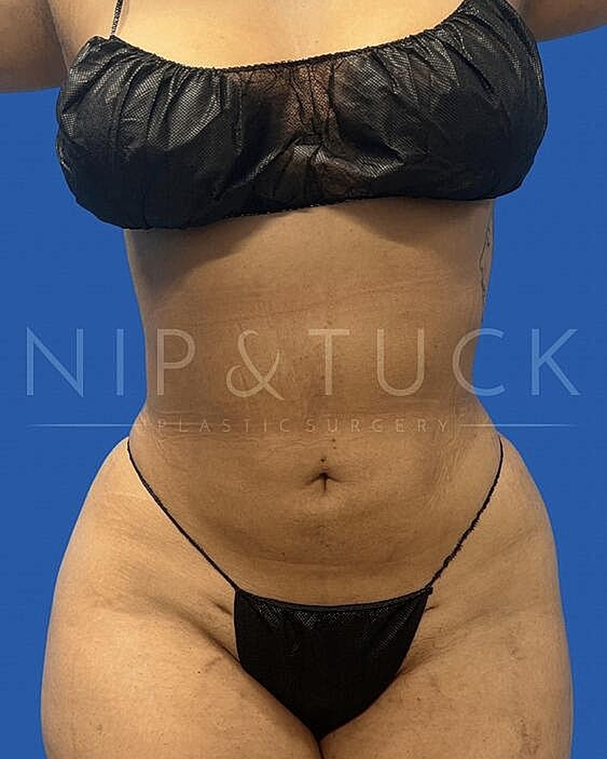 Liposuction Before & After