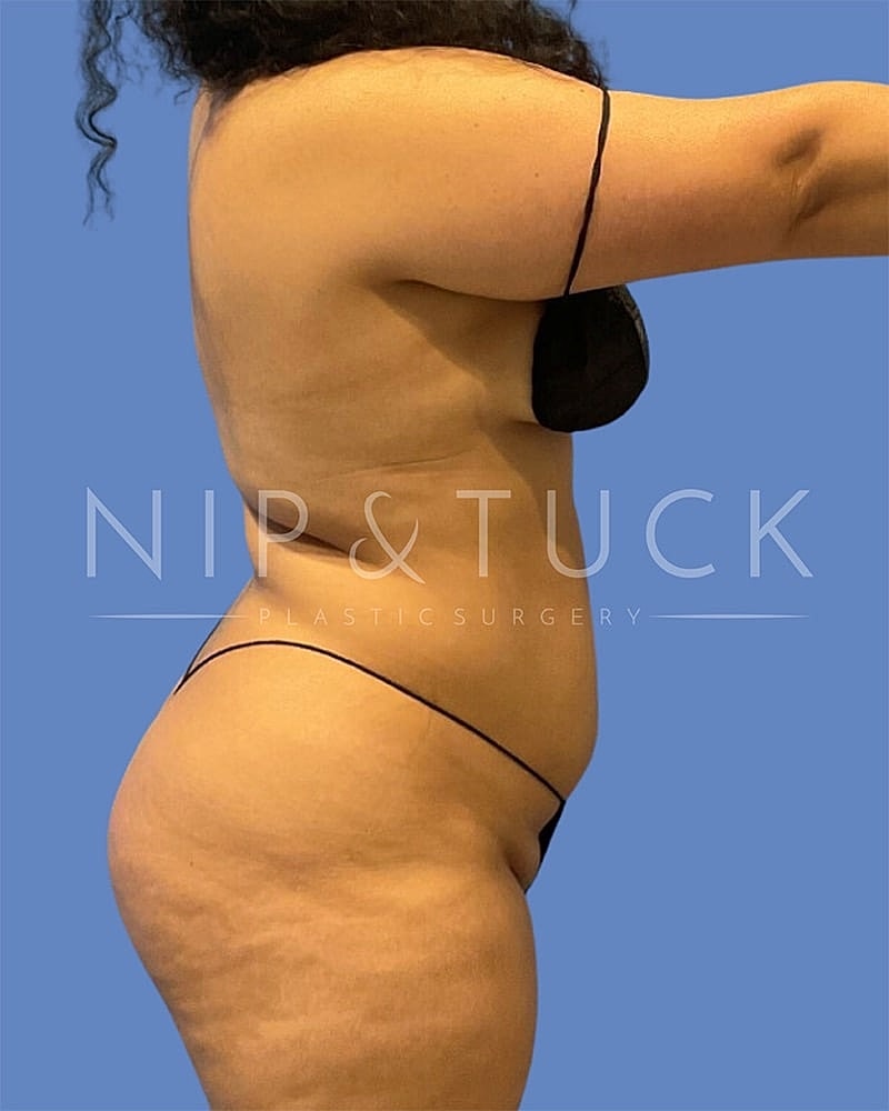 Liposuction Before & After
