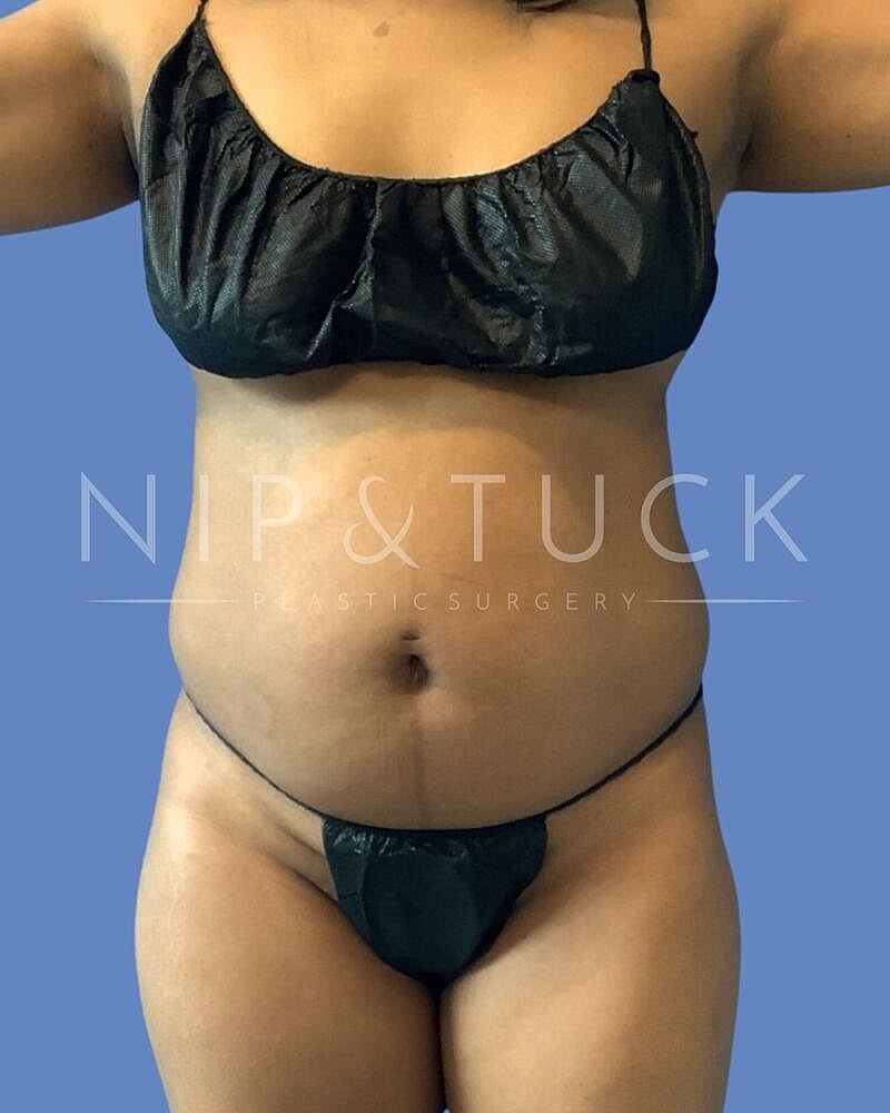 Liposuction Before & After