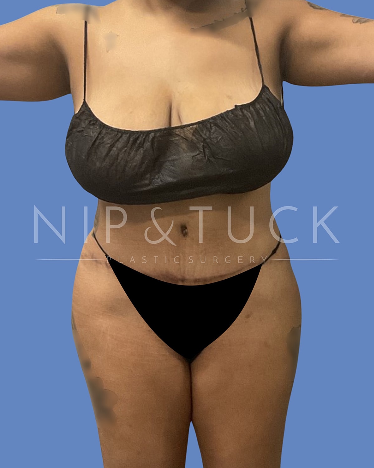 Liposuction Before & After