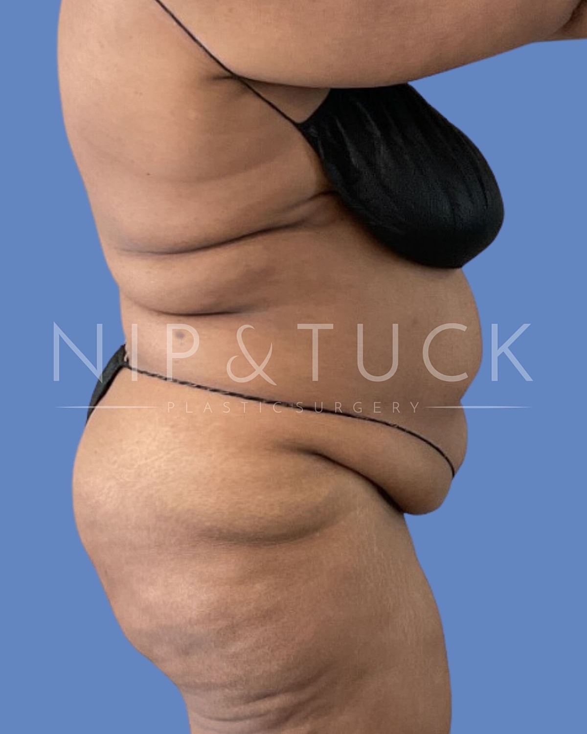Liposuction Before & After