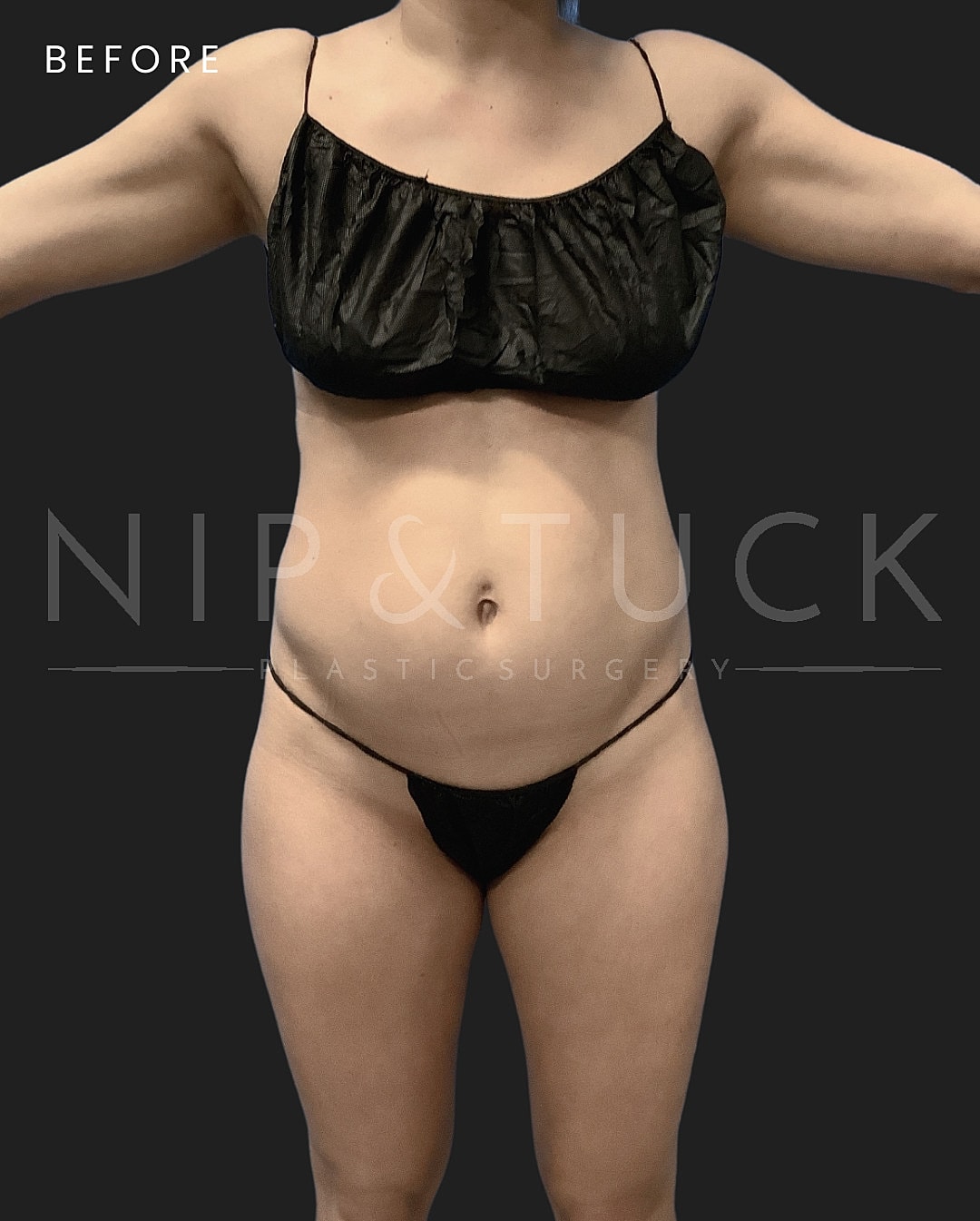 Liposuction Before & After