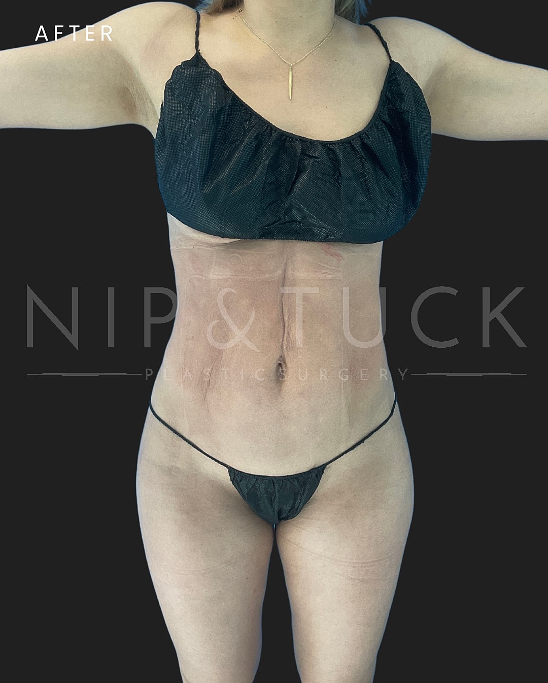 Liposuction Before & After