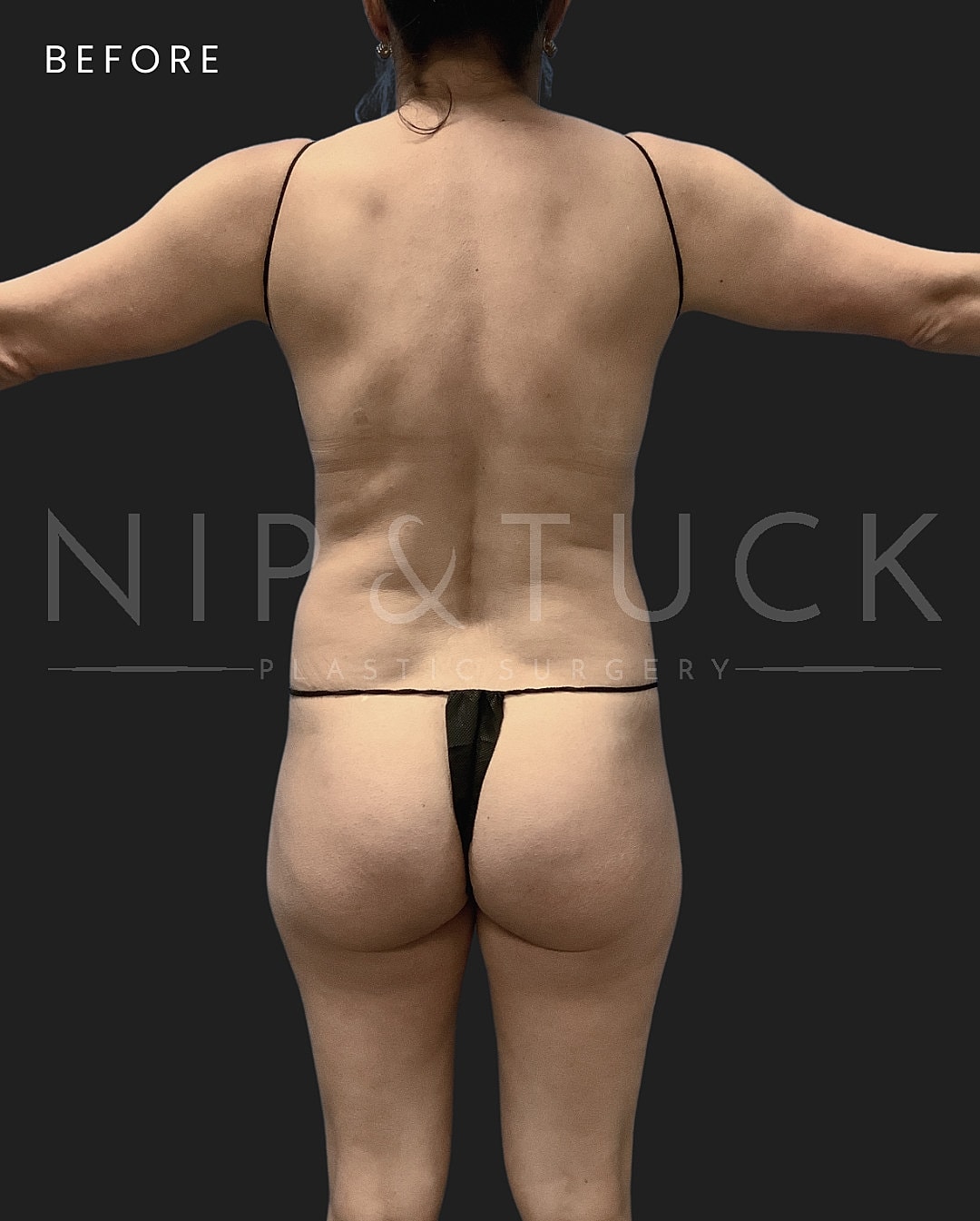 Liposuction Before & After