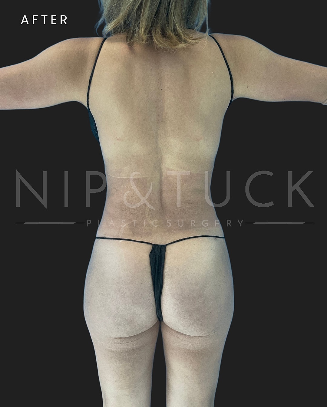Liposuction Before & After