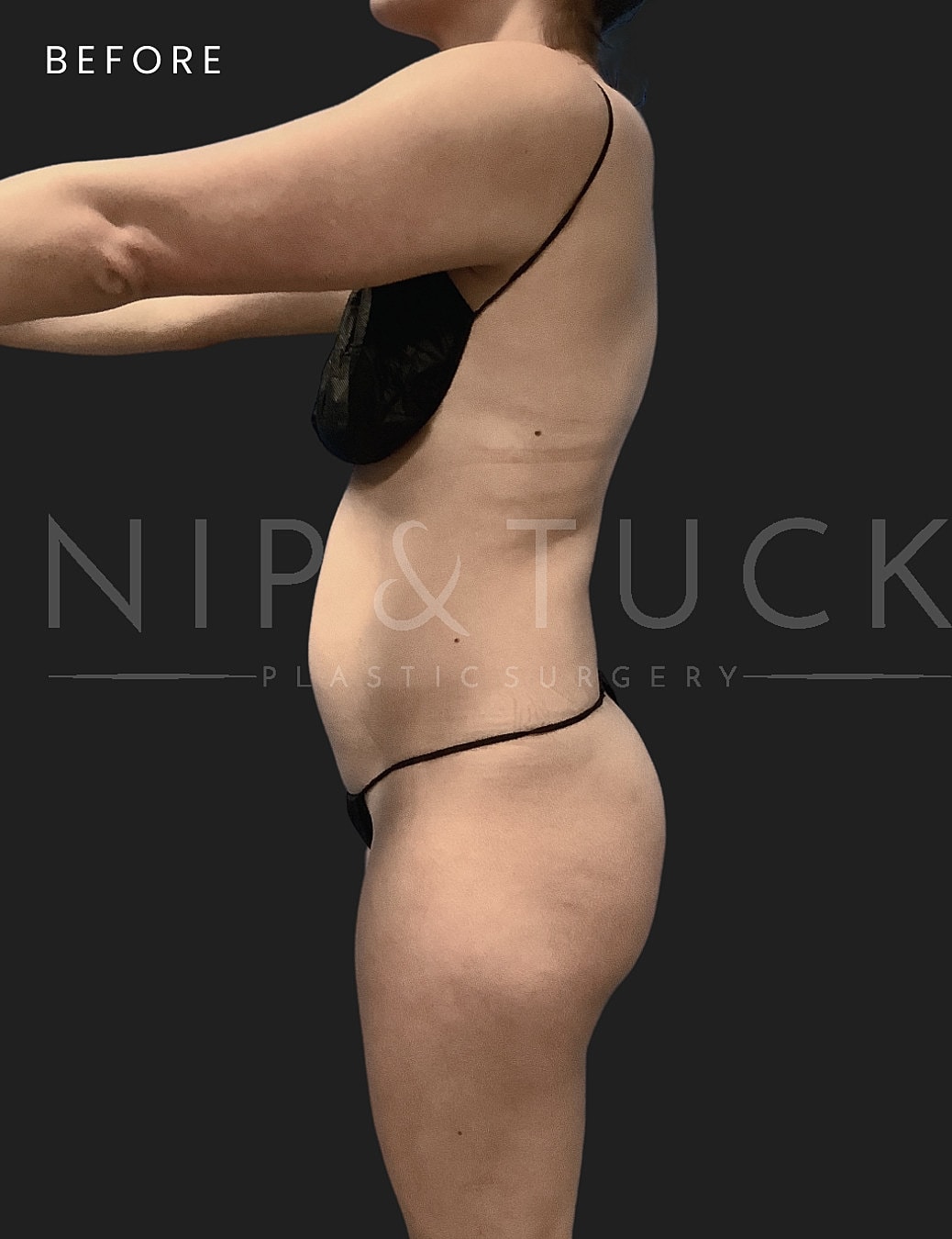 Liposuction Before & After