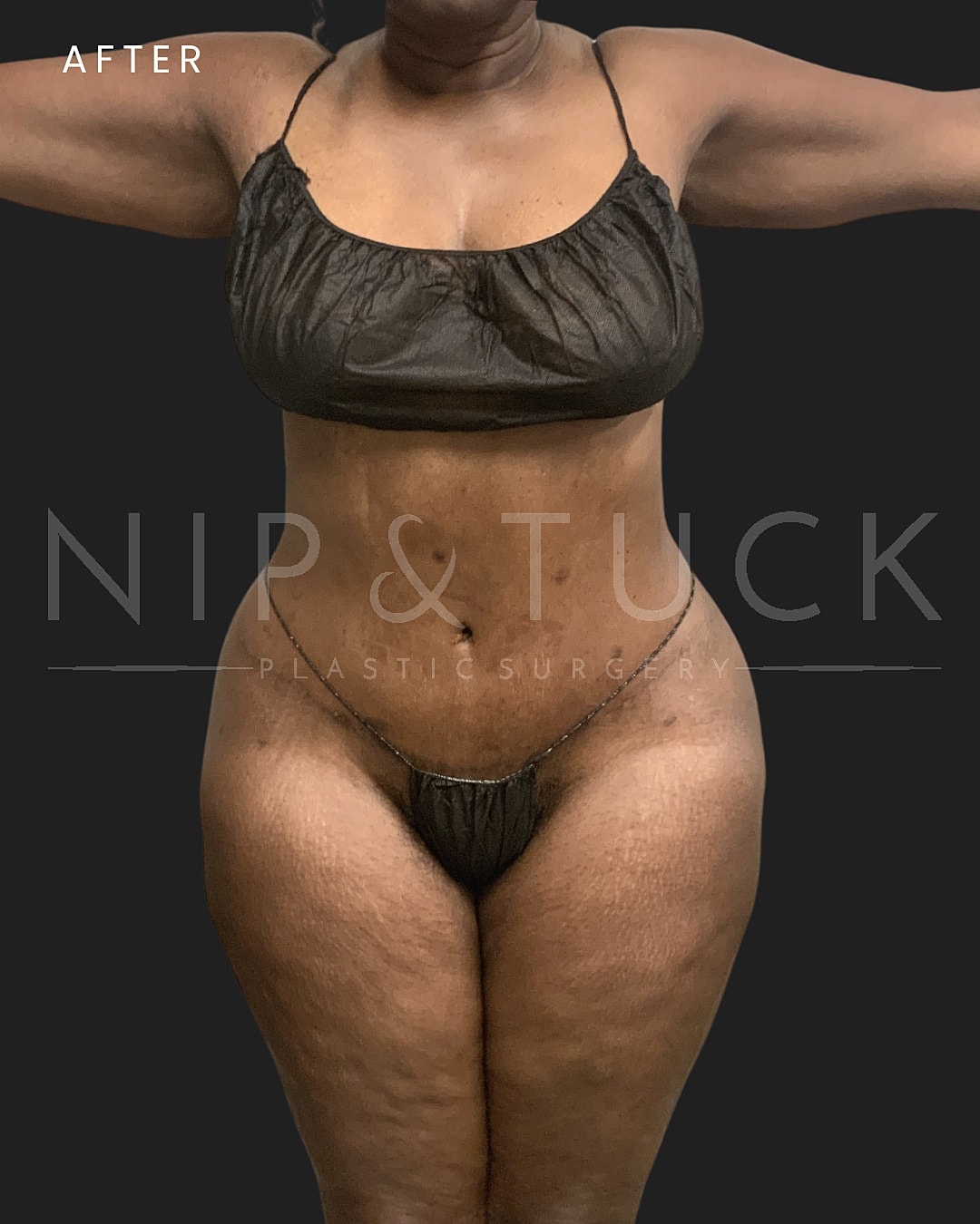Liposuction Before & After