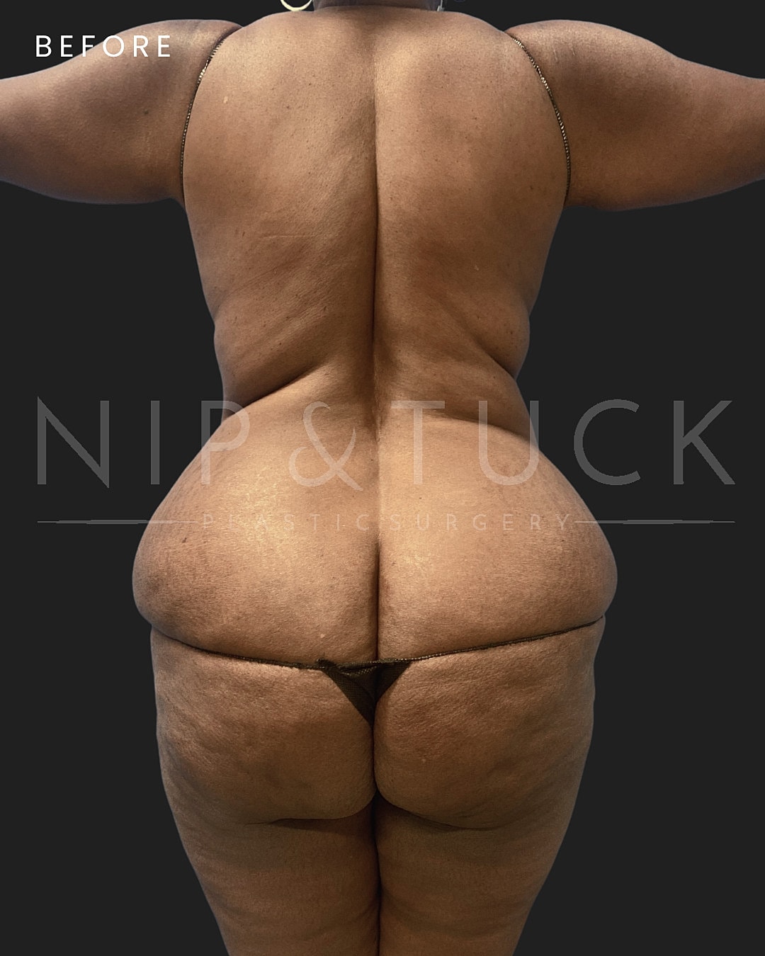 Liposuction Before & After