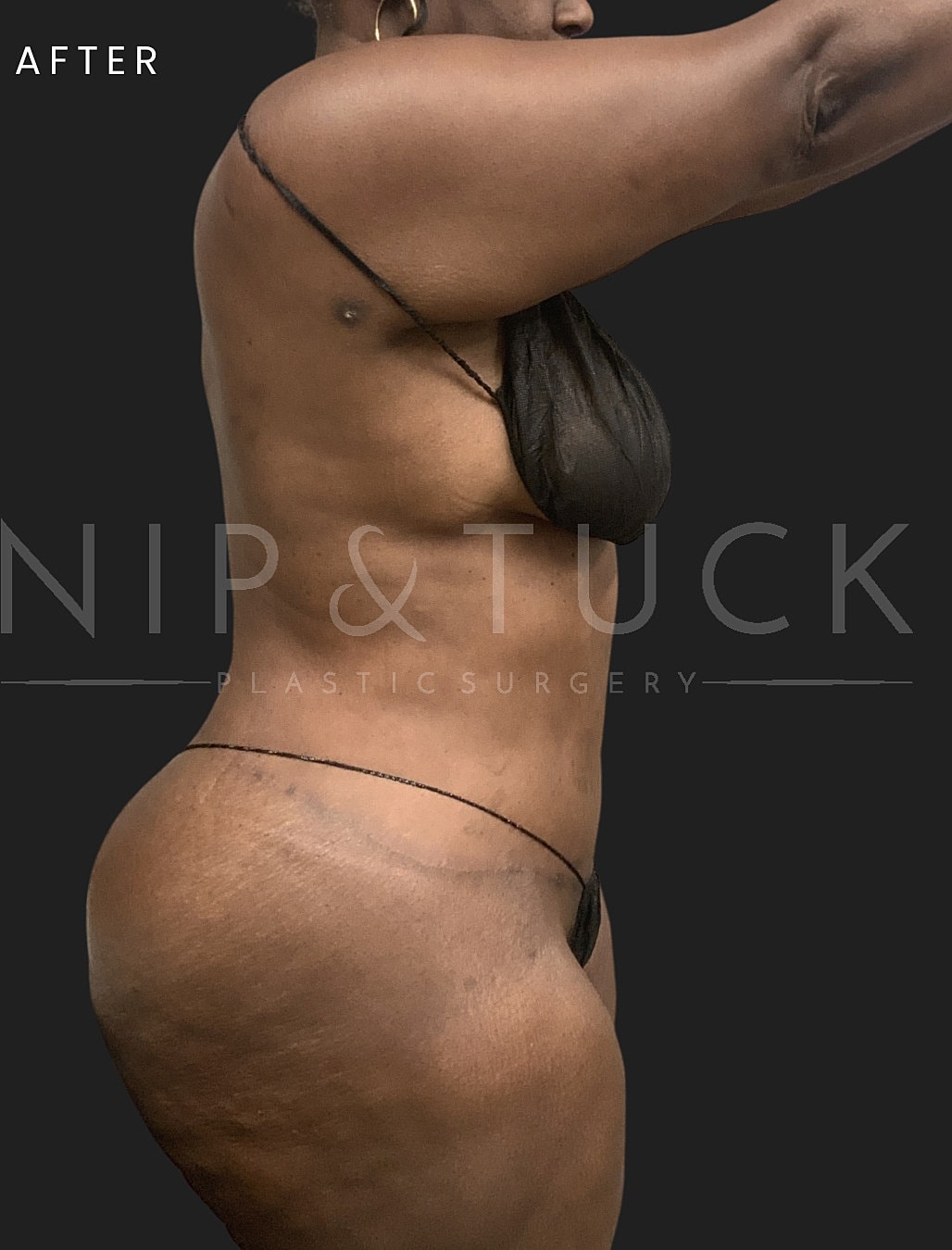 Liposuction Before & After