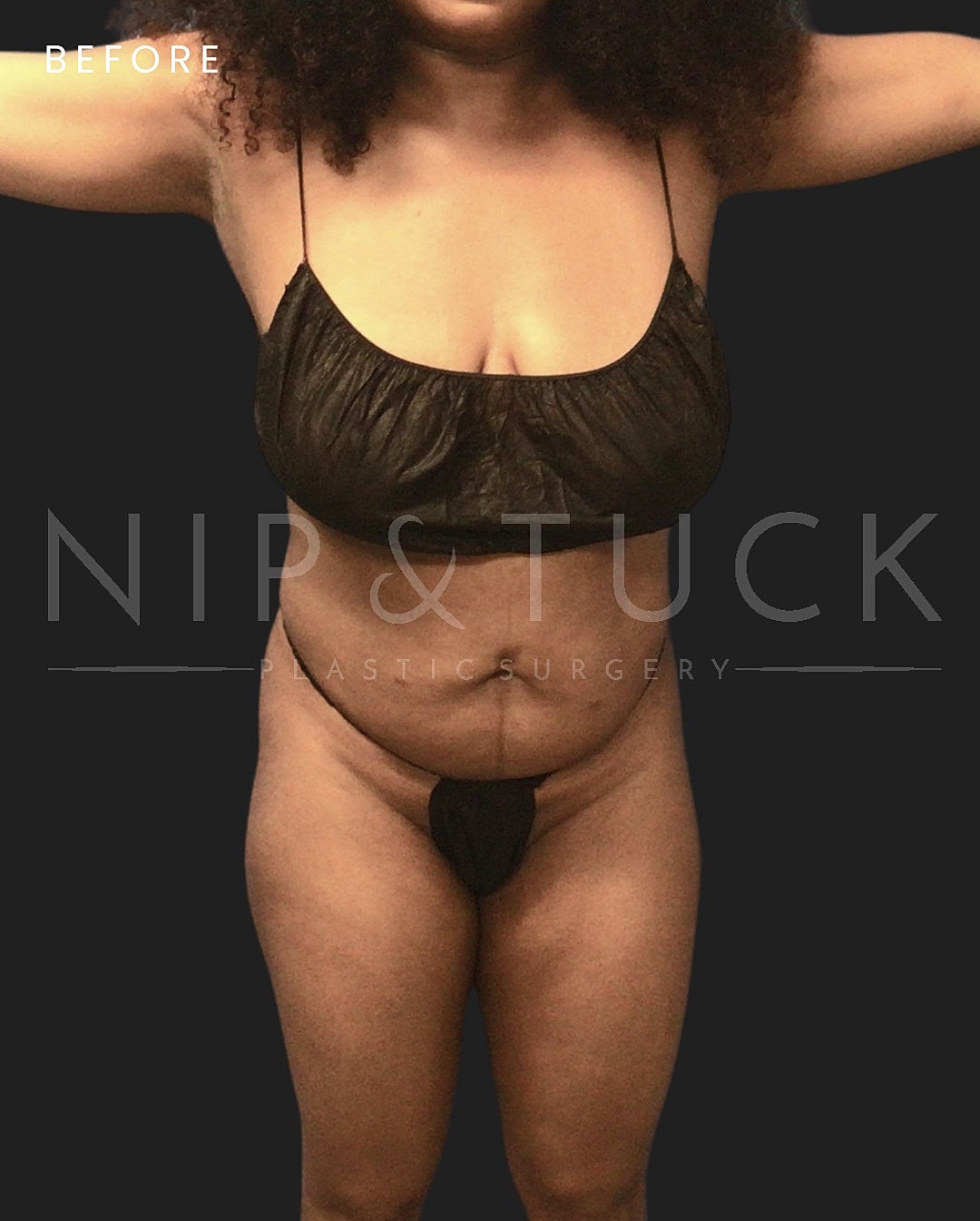Liposuction Before & After