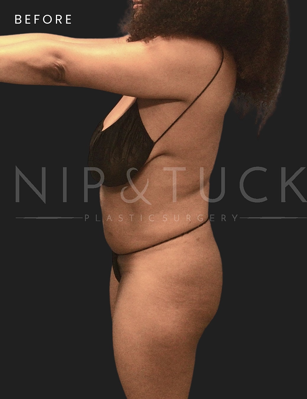 Liposuction Before & After