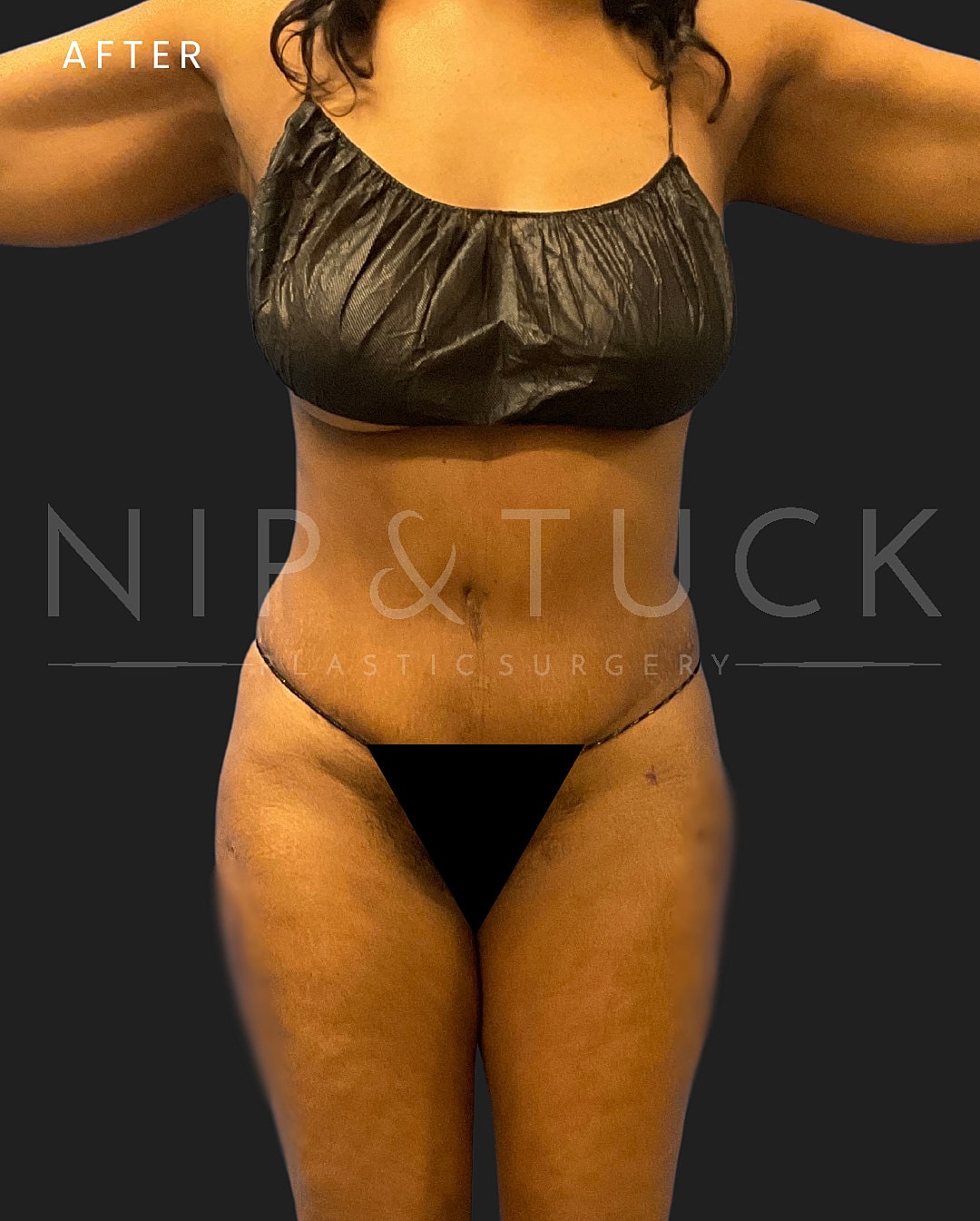 Liposuction Before & After