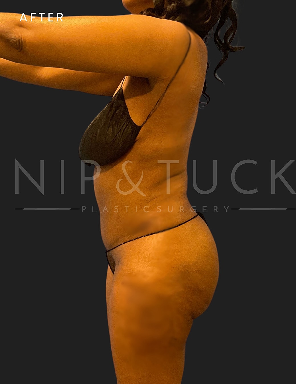 Liposuction Before & After